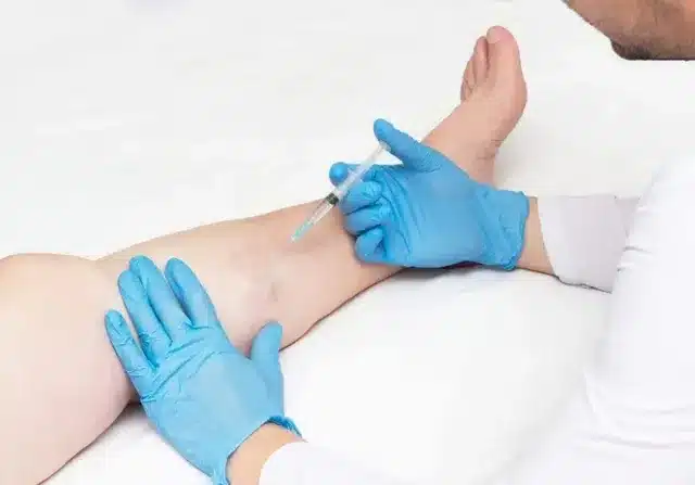 What Is Sclerotherapy | Afzal Clinics