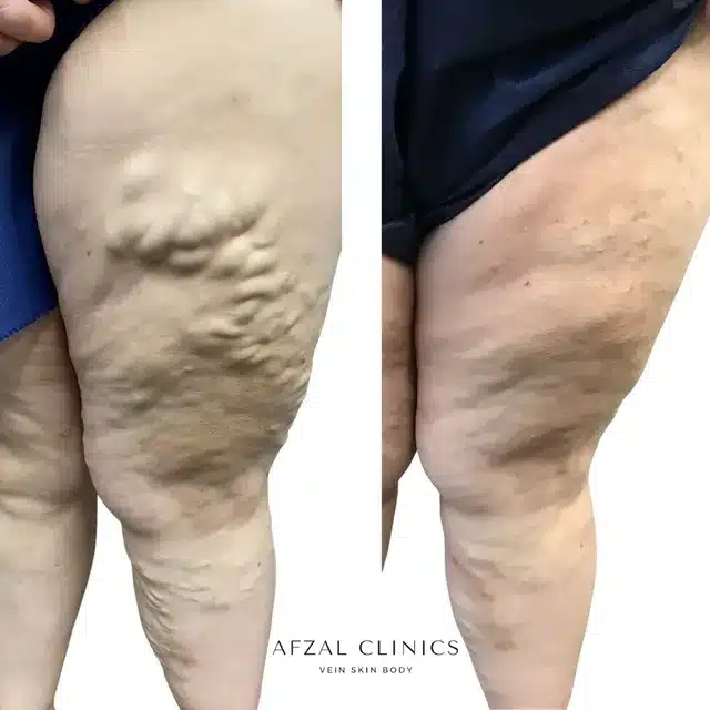 Gallery | Before and After | Back Side Varicose Veins | Afzal Clinics