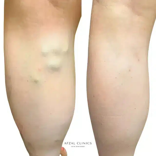 Gallery | Before and After | Back Thigh Varicose Veins | Afzal Clinics