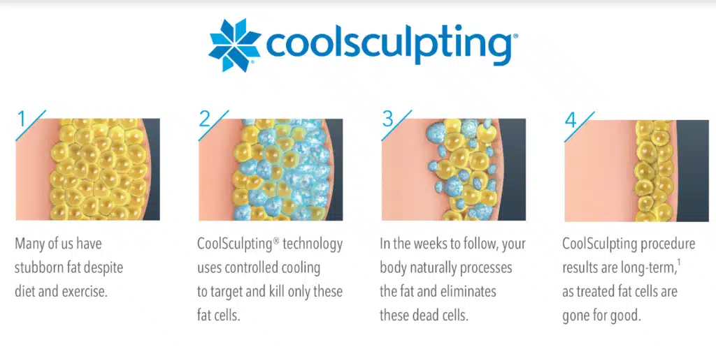 Coolsculpting by Afzal Clinics in Edina MN