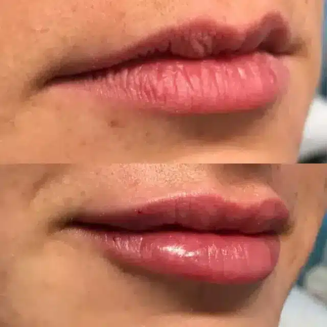 Left Side Lip Fillers | Before and After | Afzal Clinics in Fridley, MN