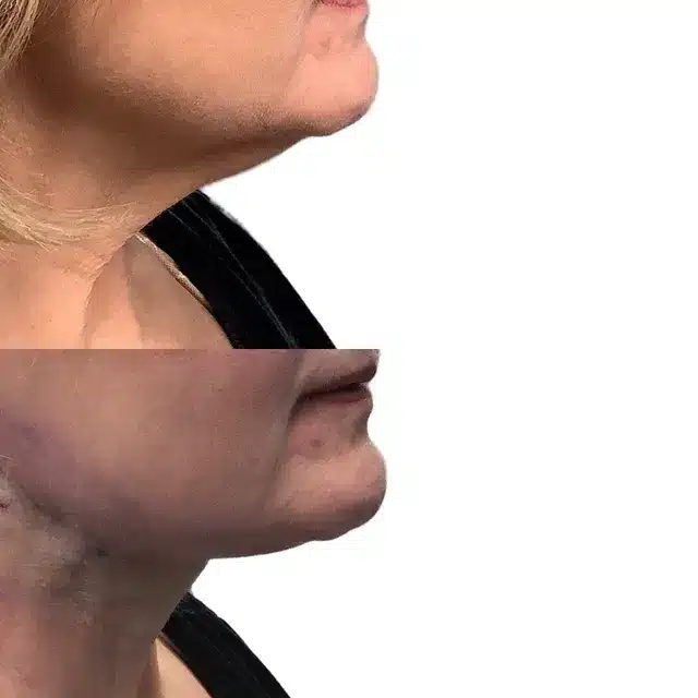 Before and After of Let Side Thread Lift Treatment | Afzal Clinics