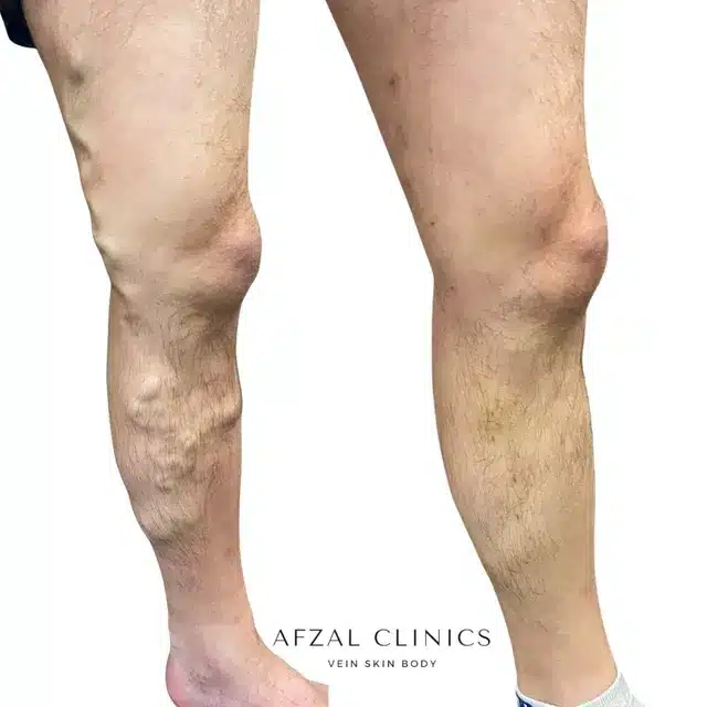 Gallery | Before and After | Left Thigh Varicose Veins | Afzal Clinics