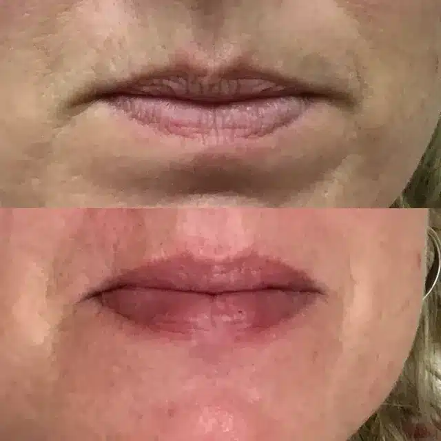 Lip Fillers | Before and After | Afzal Clinics in Fridley, MN