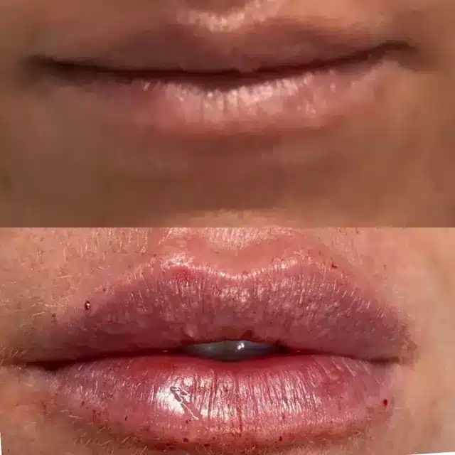 Before and After Lip Fillers by Afzal Clinics in Edina, MN and Fridley, MN