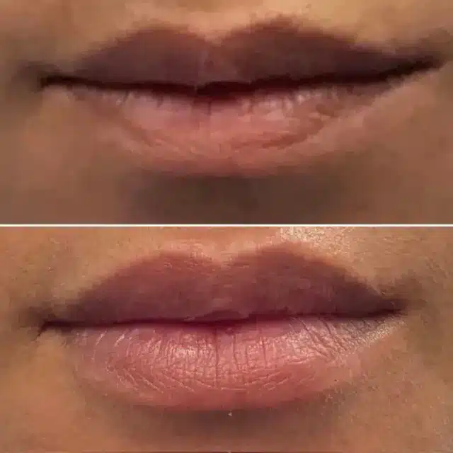 Before and After Lips Treatment by Afzal Clinics in Edina, MN and Fridley, MN