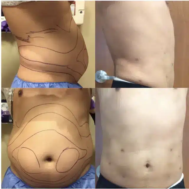 Before and After of Men Liposuction Treatment by Afzal Clinics