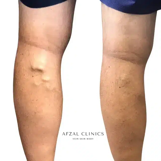 Gallery | Before and After | Men Back Side Varicose Veins | Afzal Clinics