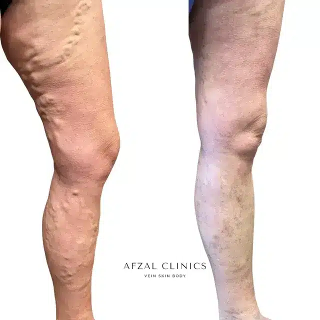 Gallery | Before and After | Men Leg Varicose Veins | Afzal Clinics