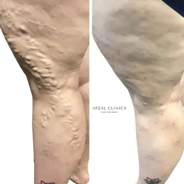 Before and After | Men Right Side Varicose Veins | Afzal Clinics