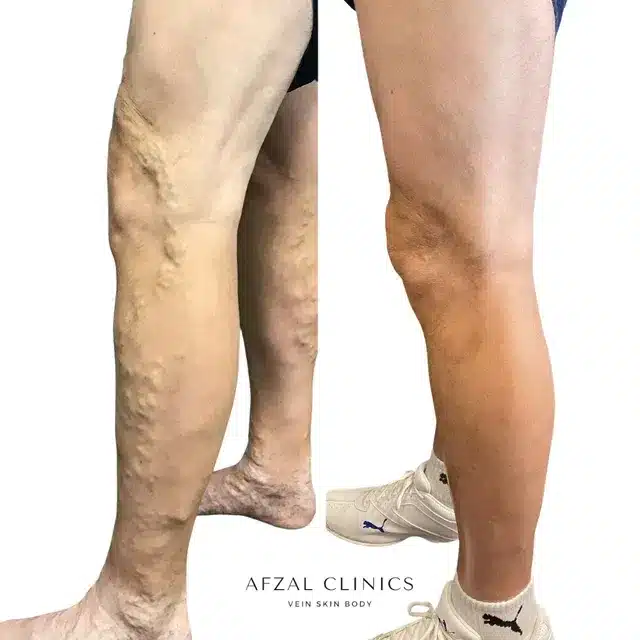 Gallery | Before and After | Right Foot Varicose Veins | Afzal Clinics