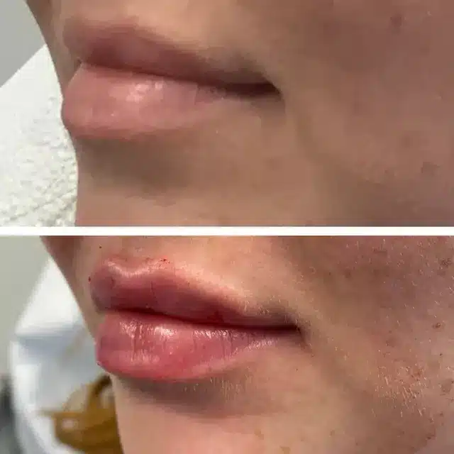 Women Right Side Lip Filler | Before and After |Afzal Clinics in Fridley, MN