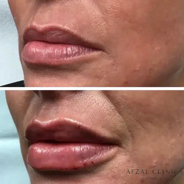 Before and After of Women Right Side Lip Filler by Afzal Clinics in Fridley, MN