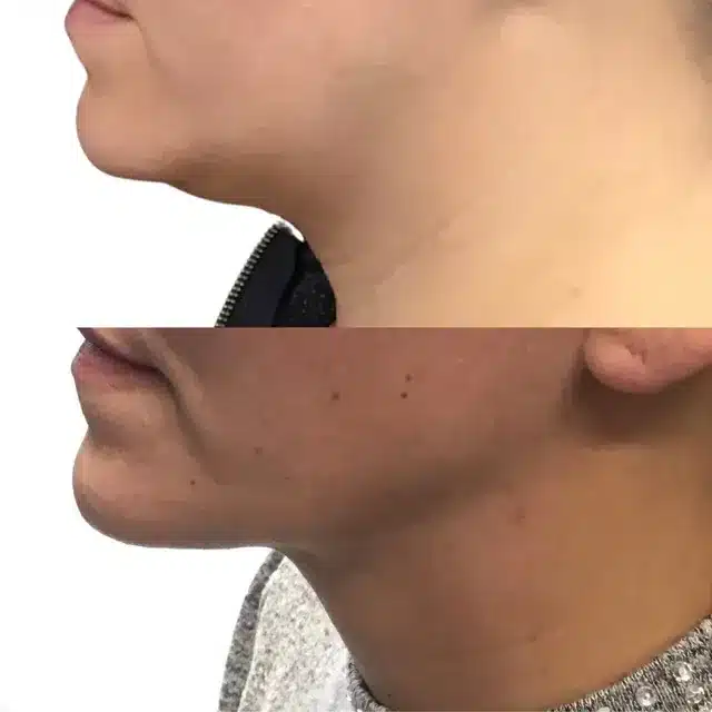 Before and After of Right Side Face Thread Lift | Afzal Clinics