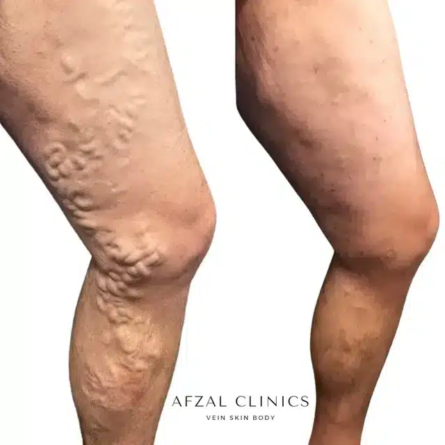 Gallery | Before and After | Right Thigh Varicose Veins by Afzal Clinics in Edina, MN and Fridley,MN