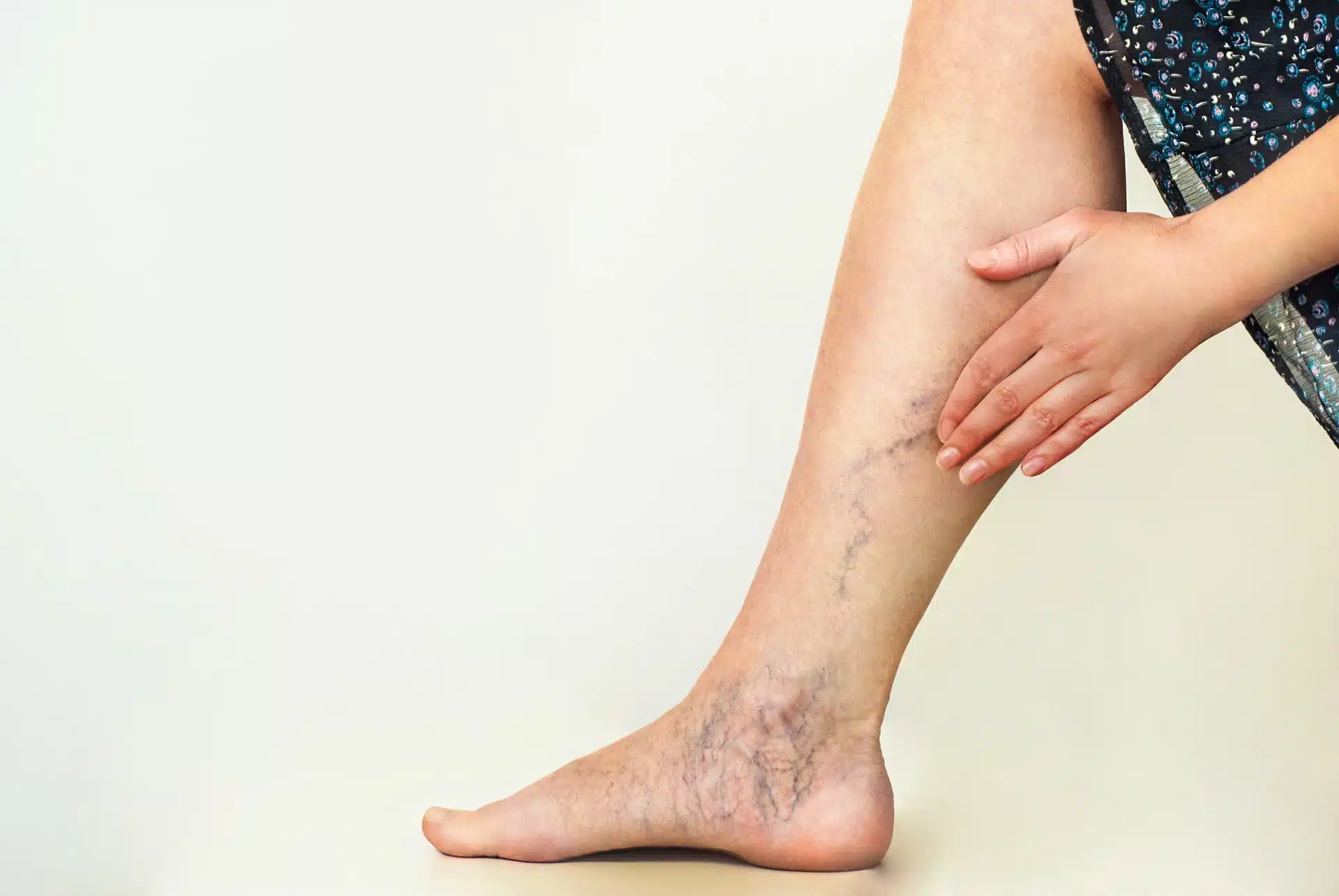 Spider Veins Treatment by Afzal Clinics in Edina, MN and Fridley, MN