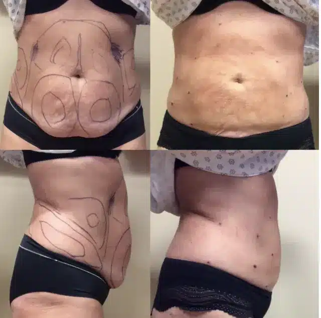 Women Stomach Liposuction Before and After Treatment | Afzal Clinics in Edina