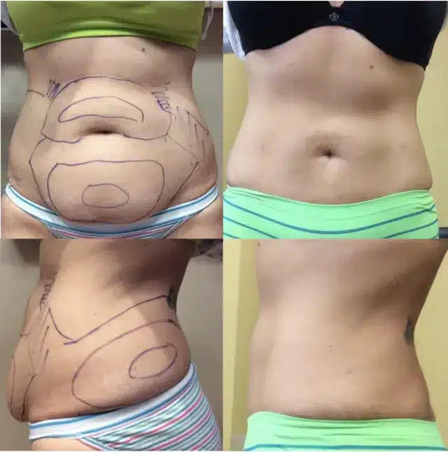 Women Stomach Liposuction | Before and After