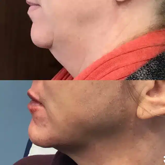 Gallery | Women Face Right Side Thread Lift Before and After | Afzal Clinics in Edina, MN