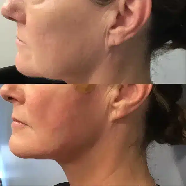 Women Face Right Side Thread Lift Before and After | Treatment by Afzal Clinics