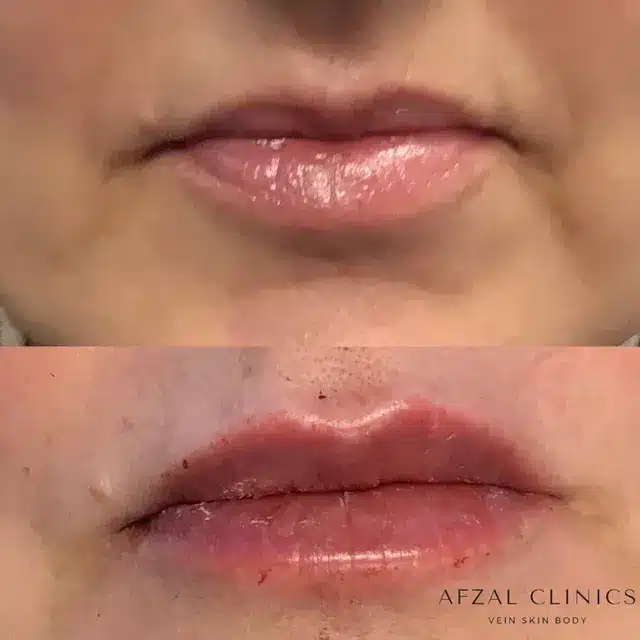 Before and After of Women Lip Filler Treatment by Afzal Clinics in Edina, MN