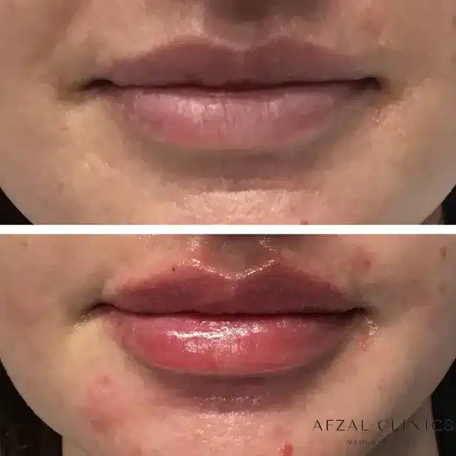 Women Lip Filler | Before and After |Afzal Clinics in Fridley, MN