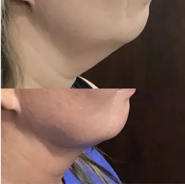 Before and After of Women Neck Treatment | Afzal Clinics