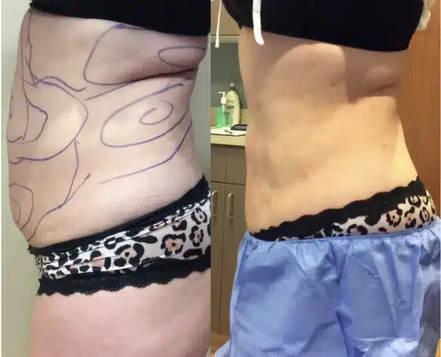 Before and After of Women Stomach Liposuction Treatment | Afzal Clinics