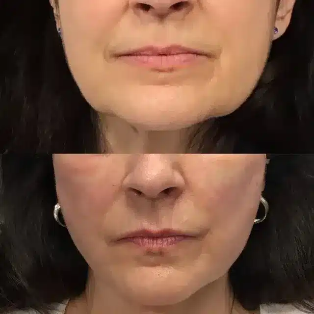 Gallery | Women Thread Lift Before and After | Afzal Clinics