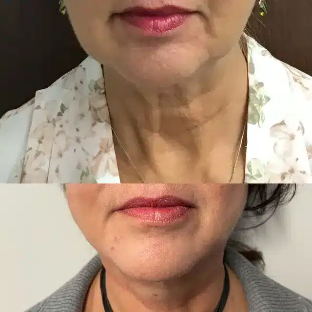 Gallery | Before and After | Women Thread Lift Treatment | Afzal Clinics