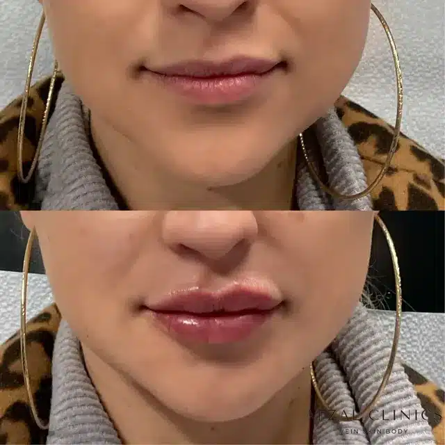 Before and After of Women Lip Filler Treatment by Afzal Clinics in Edina, MN