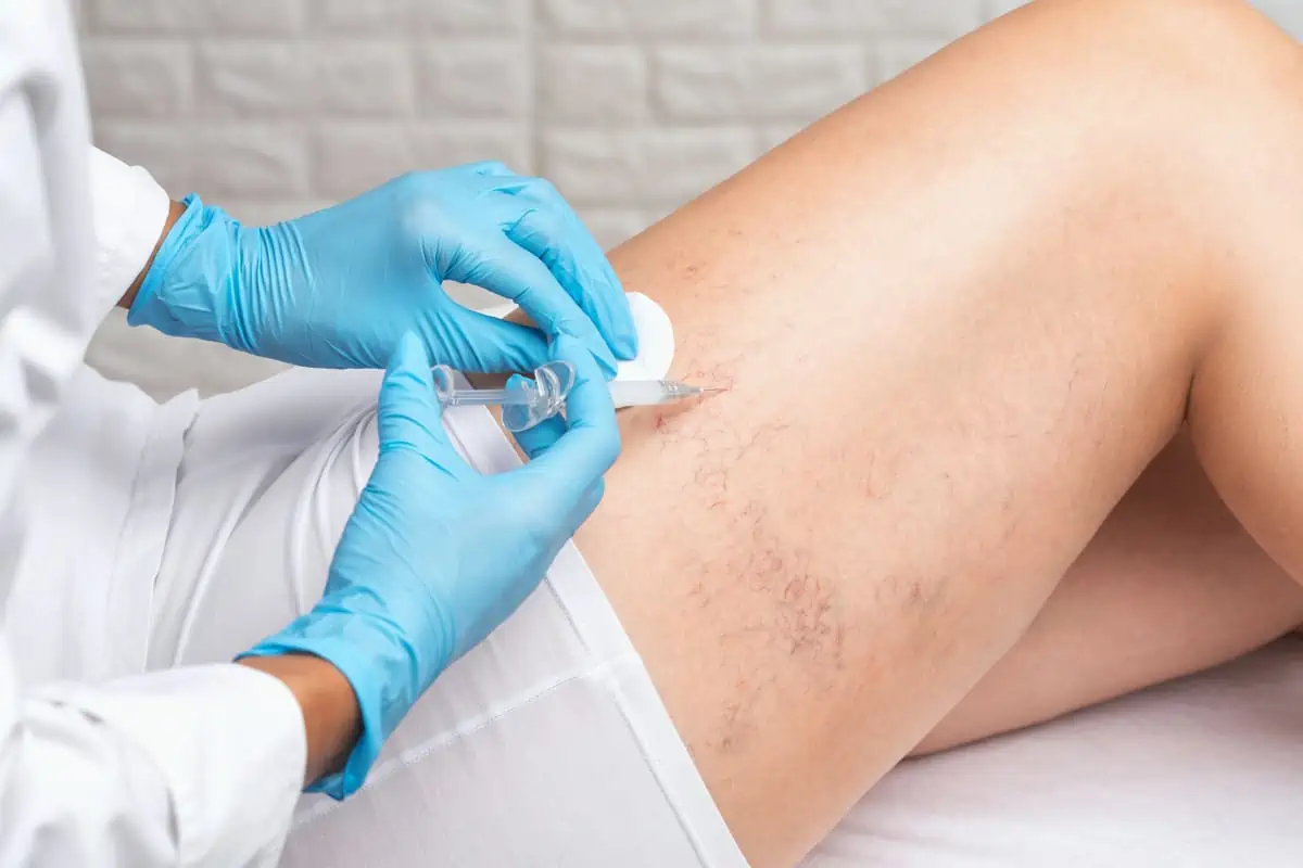 Cosmetic Sclerotherapy by Afzal Clinics in Edina MN