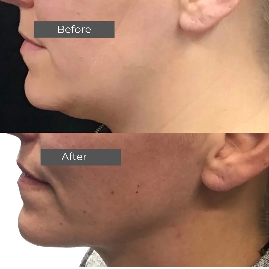 before and after image of a neck liposuction procedure