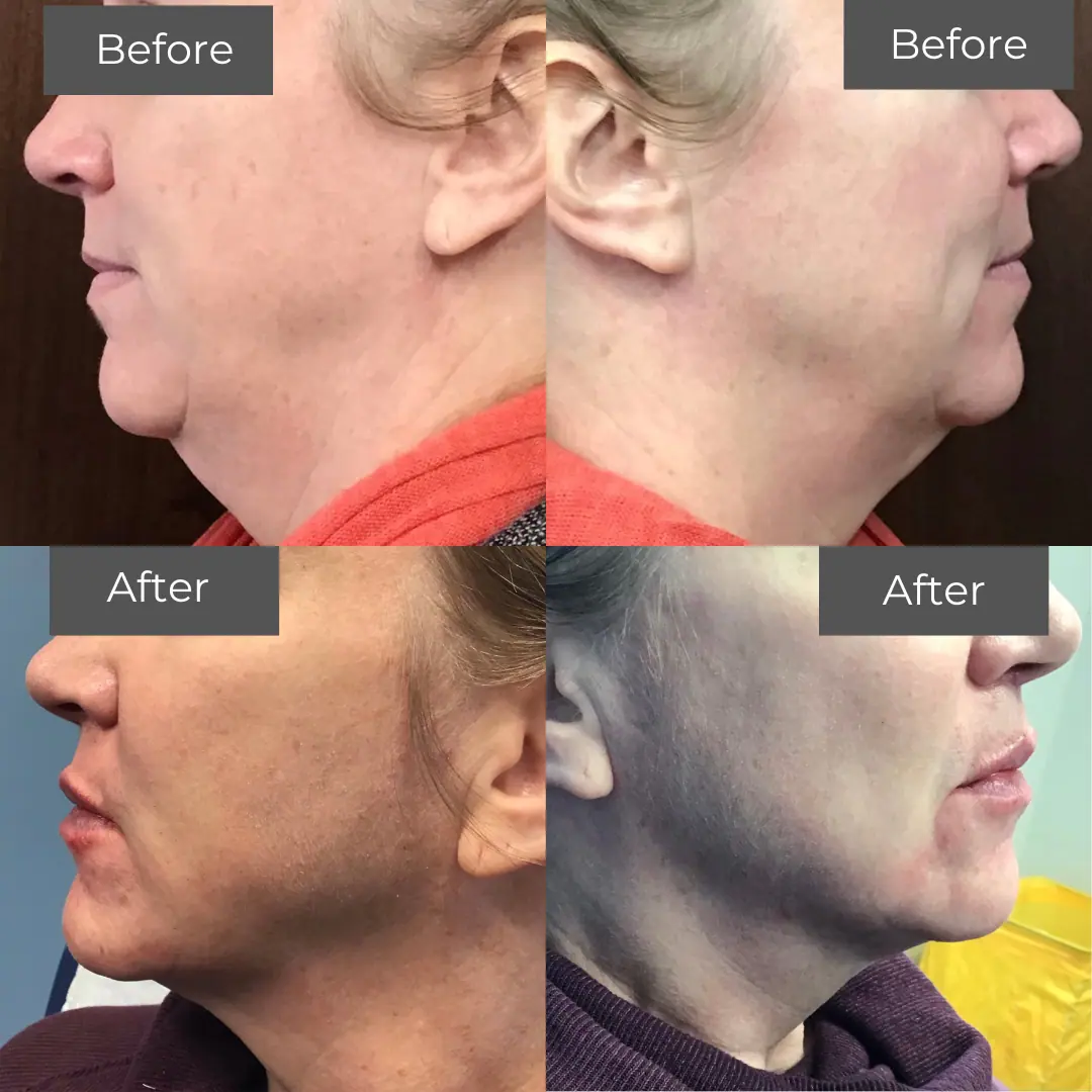 before-and-after comparison of a neck liposuction procedure