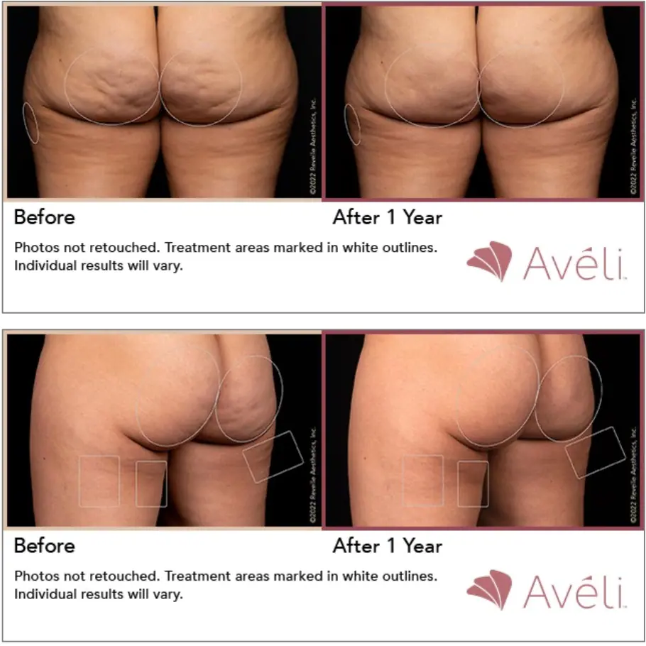 Aveli cellulite reduction on buttocks Before and After image