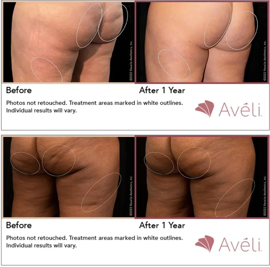 Before and after Aveli treatment on the glutes