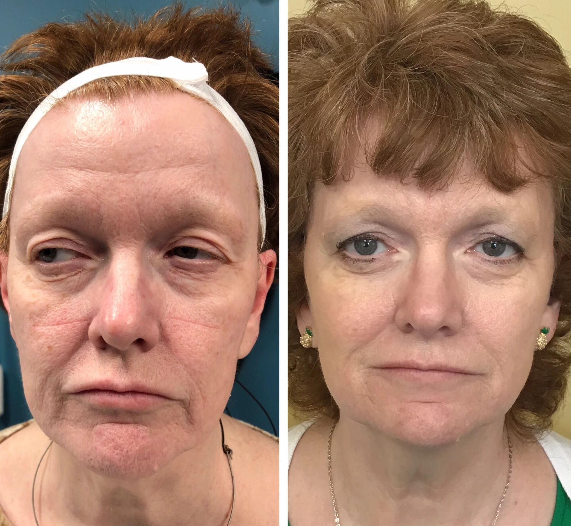 Before and after results of Halo laser treatment