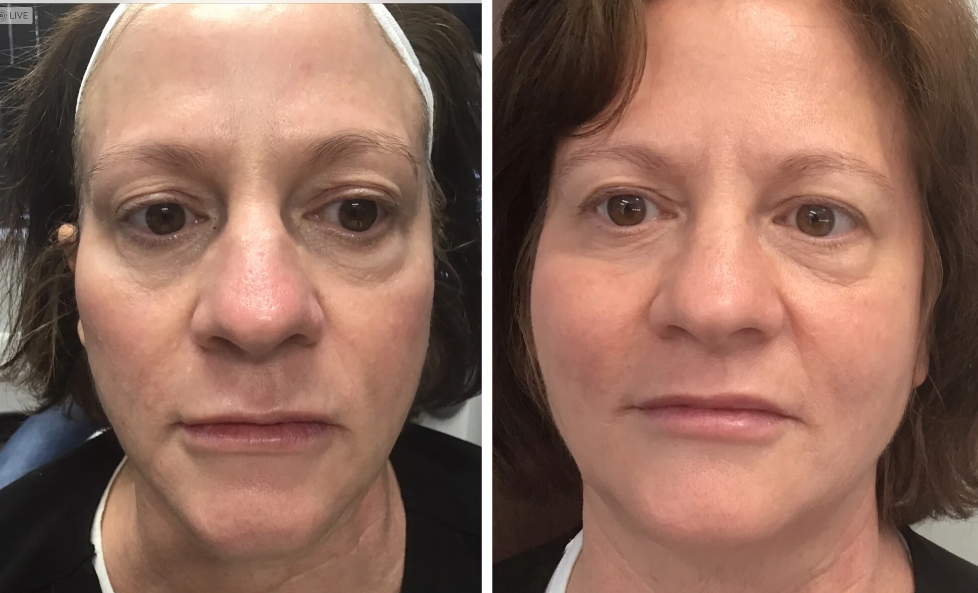 Before and after results of Halo laser treatment