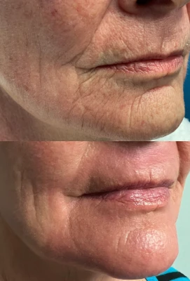 Laser Resurfacing before and after image right side profile