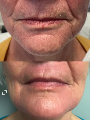 Laser Resurfacing before and after image front profile