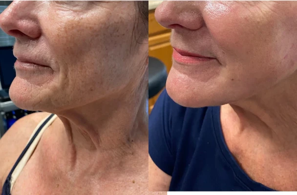 Laser Resurfacing before and after image left side profile