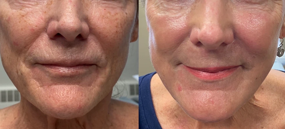 Laser Resurfacing before and after image front closeup