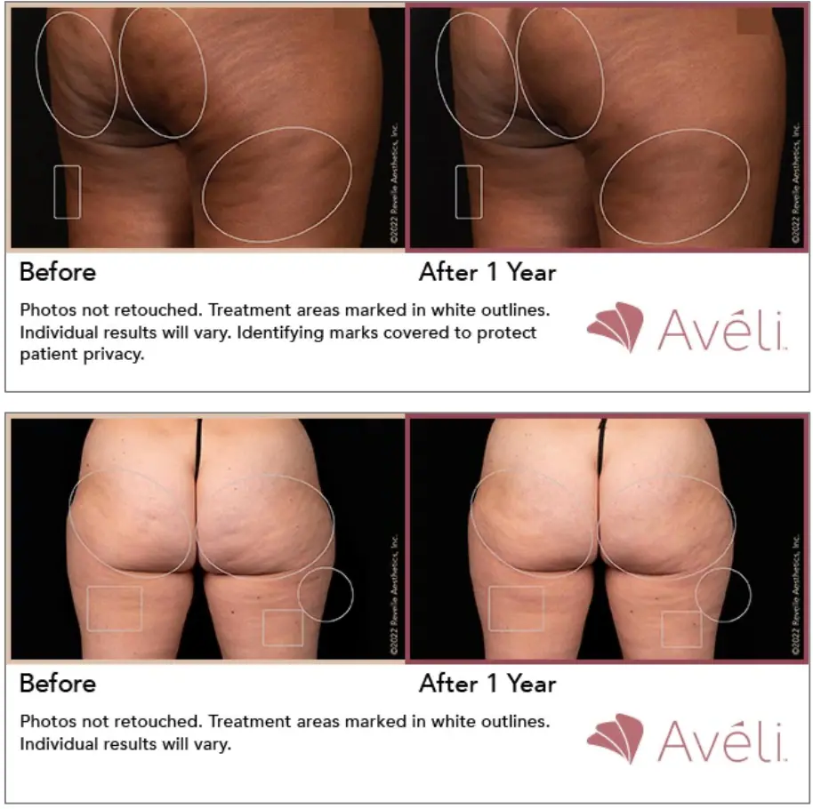 Avéli Cellulite Treatment Before and After - 1-Year Results