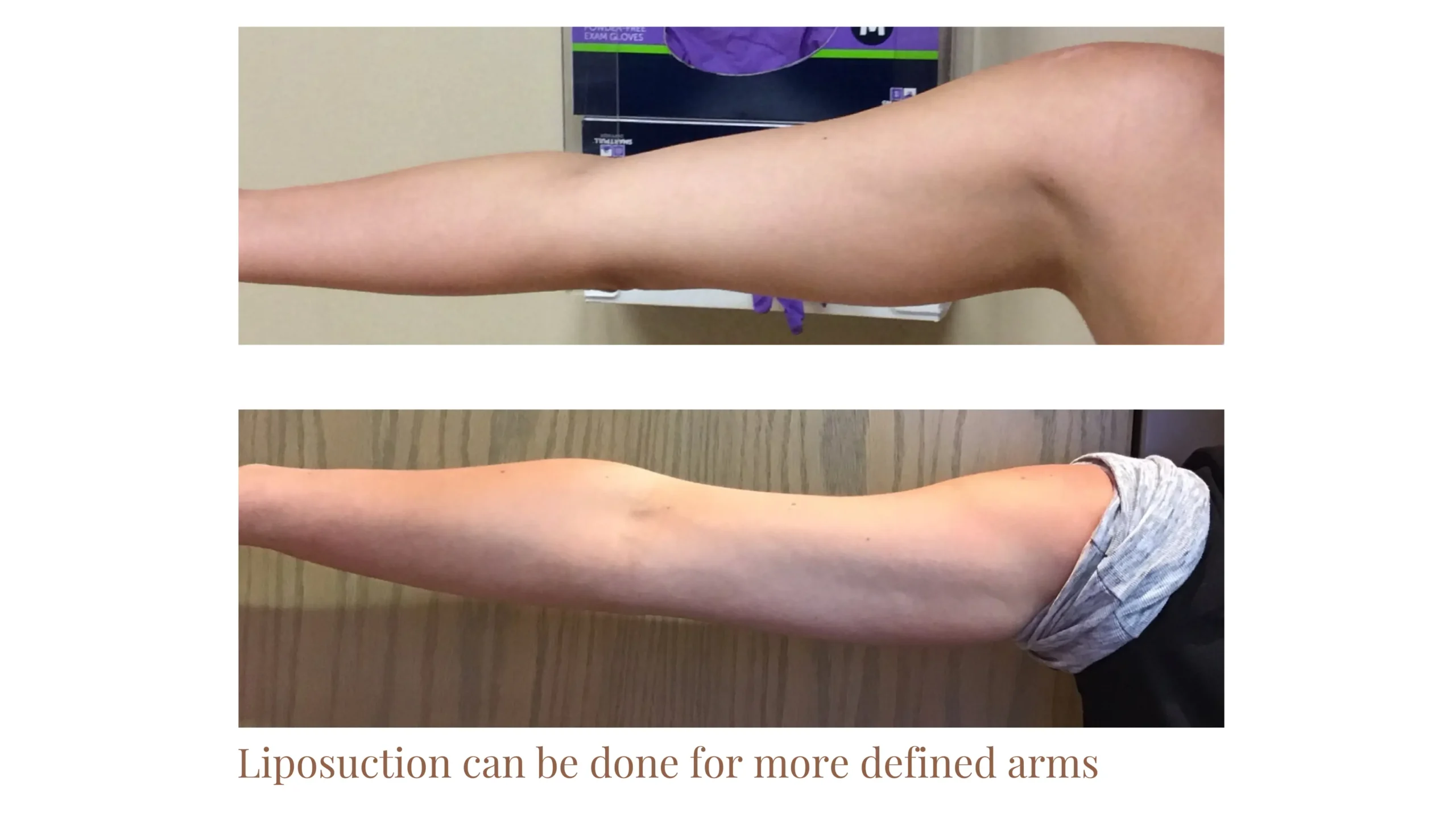 Arm Liposuction Before and After - More Defined Arms