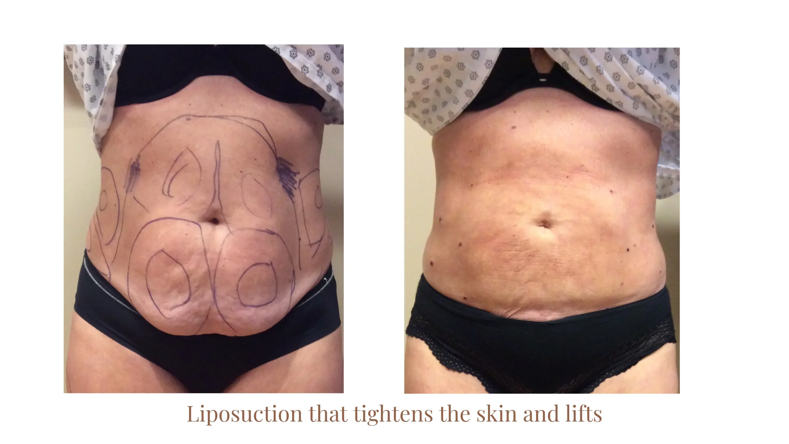 Liposuction Before and After - Front Profile