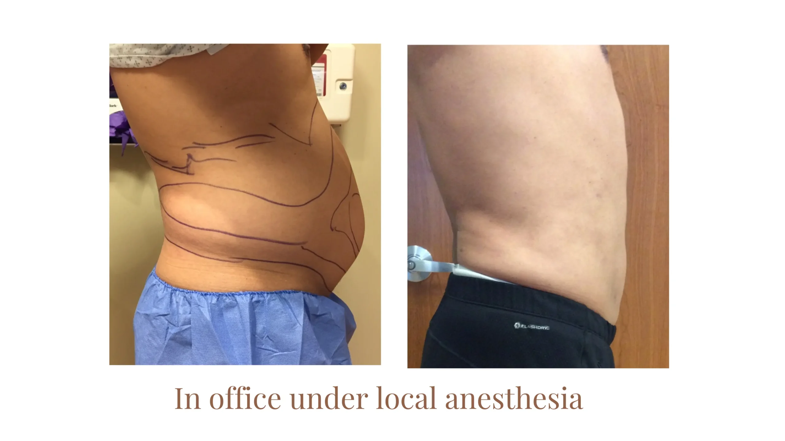 Liposuction Before and After - Right Side Profile