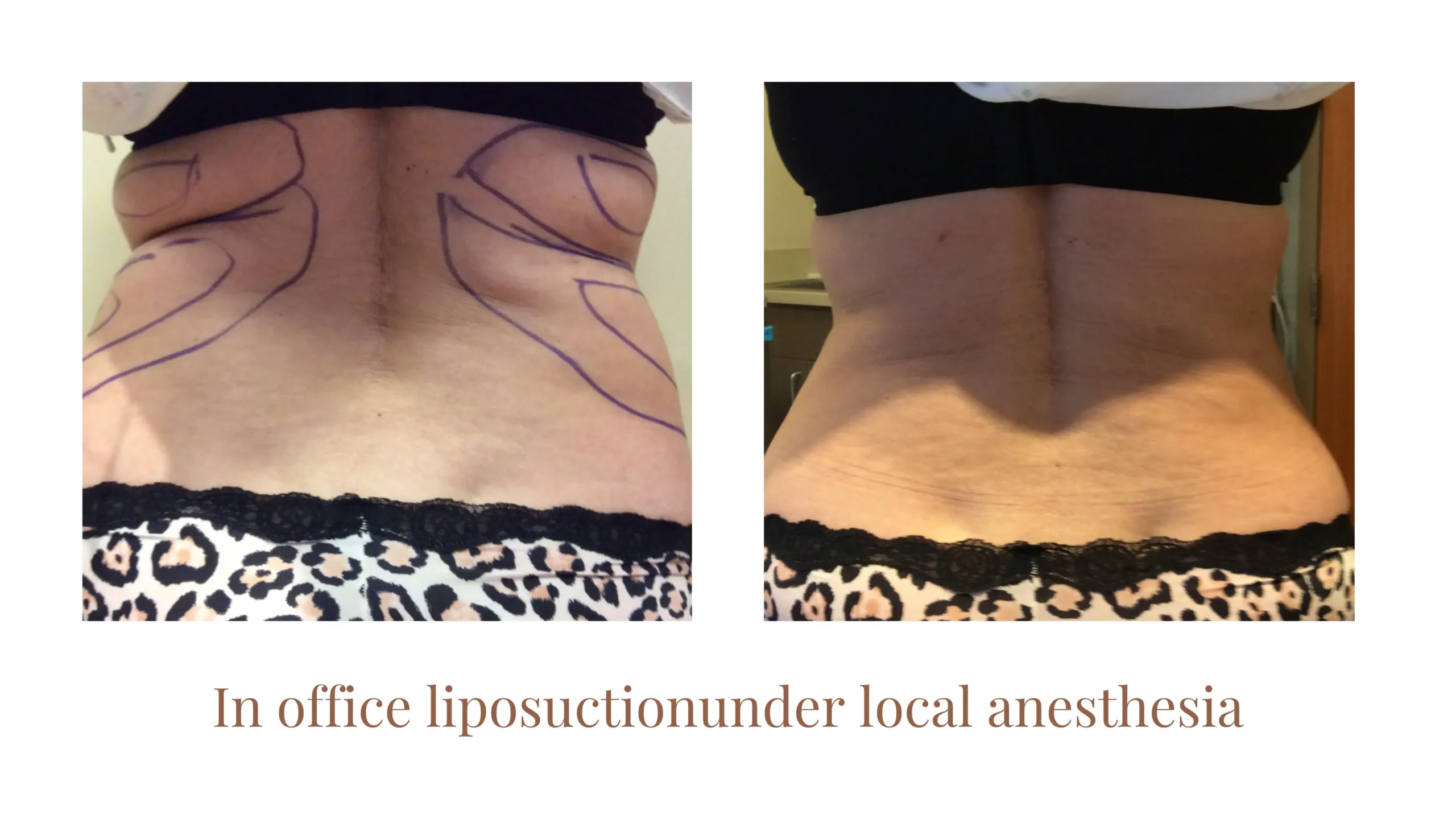 Liposuction Before and After - Back Profile