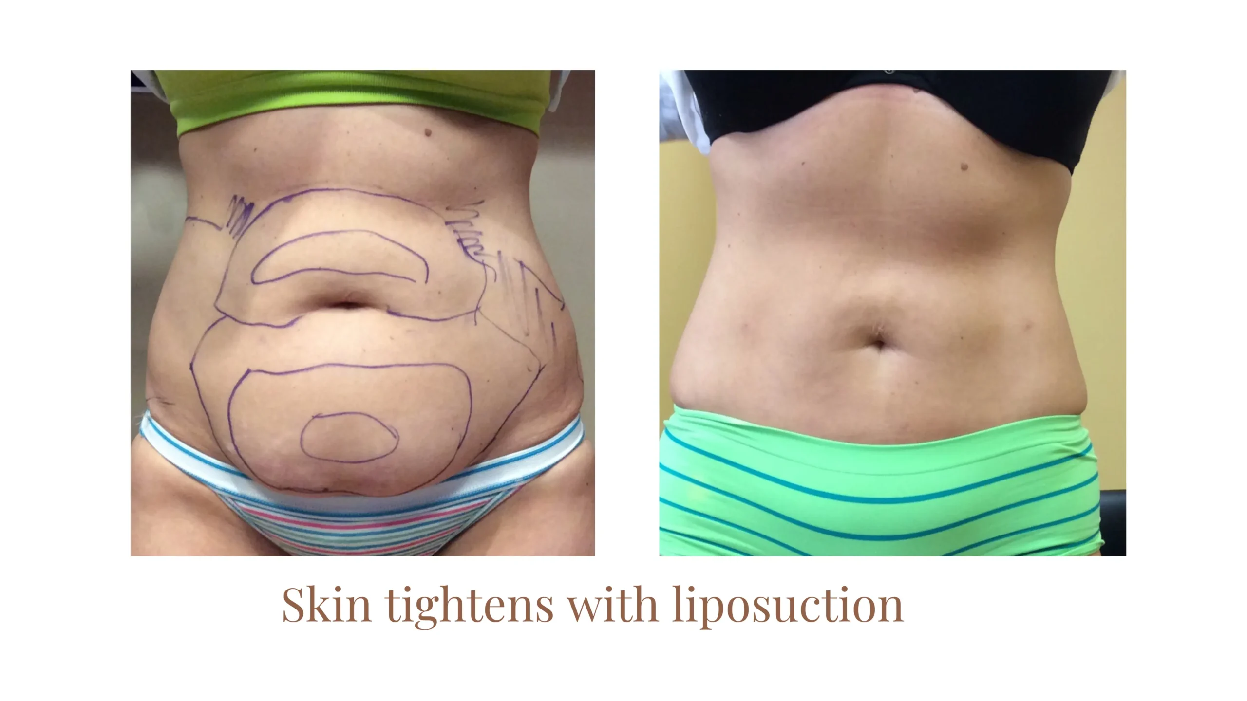 Liposuction Before and After - Front Profile