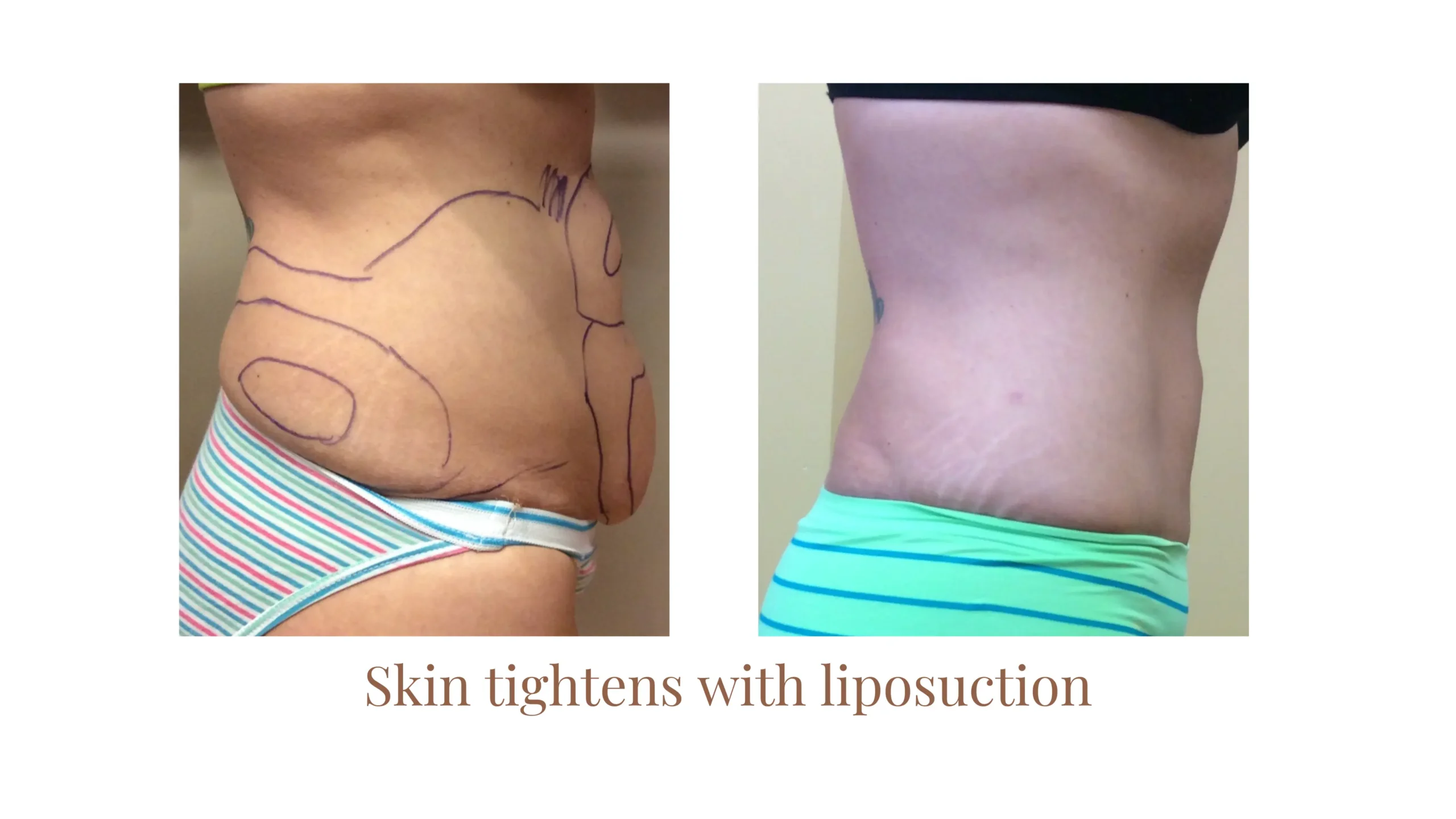 Liposuction Before and After - Right side profile