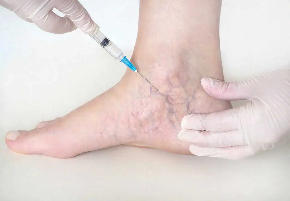 Sclerotherapy by Afzal Clinics in Edina, MN